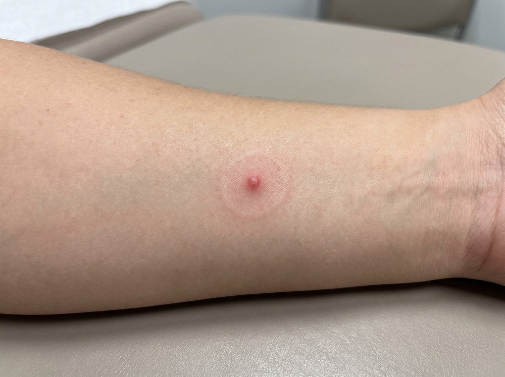 Close-up of a fresh Arizona bark scorpion sting on skin showing a small pinpoint red mark with minimal visible swelling