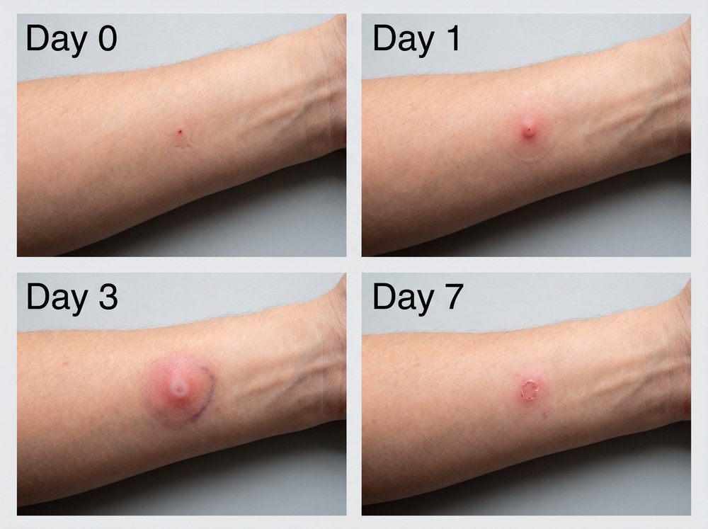 Four panel progression photo of an Arizona bark scorpion sting site at hour zero, day one, day three, and day seven showing fading discomfort